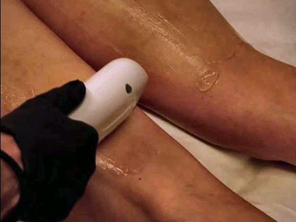 Laser hair removal